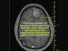 迈克尔-普林克妻子在社交媒体上上传的迈克尔-普林克核磁共振成像扫描图