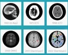 Darmiyan BrainSee 医疗人工智能软件可以早期发现阿尔茨海默氏症的迹象。(来源：Darmiyan）