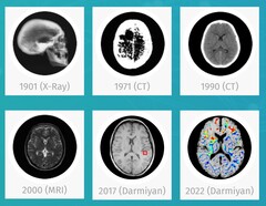 Darmiyan BrainSee 医疗人工智能软件可以早期发现阿尔茨海默氏症的迹象。(来源：Darmiyan）