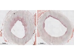 输注纳米疗法前后动脉中的斑块水平。(图片来源:今日密苏里大学)